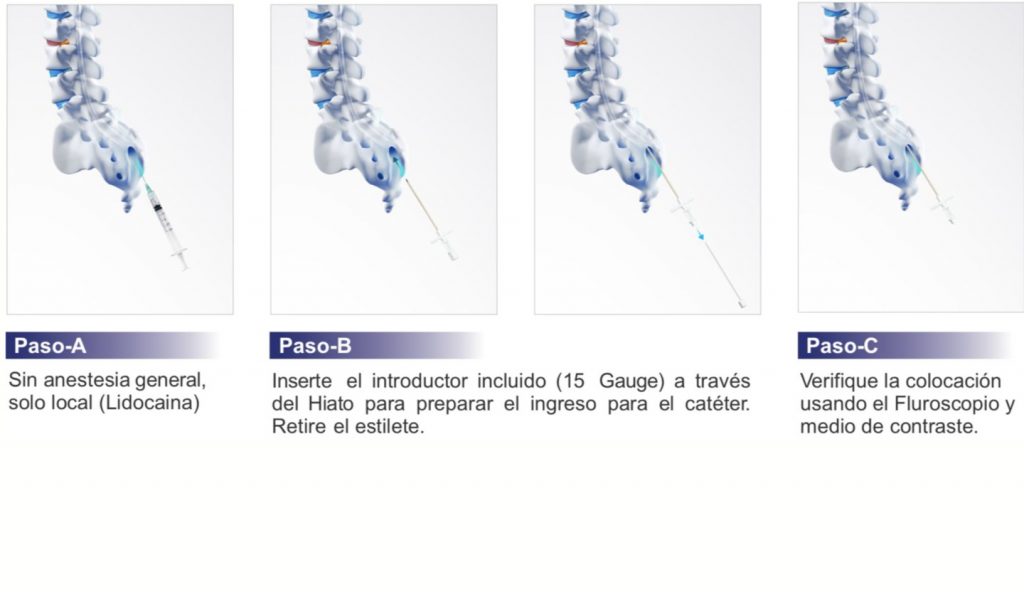 Catéter Epidural Dirigible St REED Plus Neuroservice